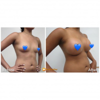 Breast Augmentation  3