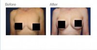 Breast Augmentation with Implants or Fat Transfer with Dr. Kenneth Benjamin Hughes in Los Angeles 8