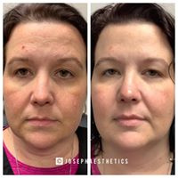 Botox forehean wrinkles and crow's feet before/after 13