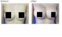 Breast Augmentation with Silicone Breast Implants or Breast Fat Transfer with Dr. Kenneth Hughes 40