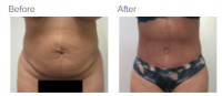 Tummy Tuck Los Angeles with Dr. Kenneth Hughes 98