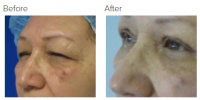 Eyelid Surgery Los Angeles with Dr. Kenneth Hughes 112