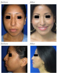 Rhinoplasty and Chin Implant with Dr. Kenneth Hughes 140
