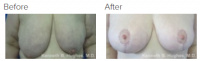 Breast Augmentation and Lift with Dr. Kenneth Benjamin Hughes 13