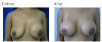 Breast Augmentation Revision with Dr. Kenneth Benjamin Hughes 20