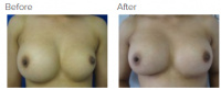 Breast Augmentation Revision with Dr. Kenneth Benjamin Hughes 21