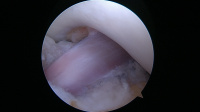 Anatomic Bone-Patellar Tendon-Bone Anterior Cruciate Ligament (ACL) Reconstruction 1
