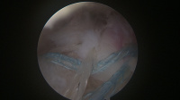 Arthroscopic Double Row Rotator Cuff Repair improves pain, healing, and function. 3
