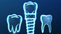 VIP Dental Implants 4