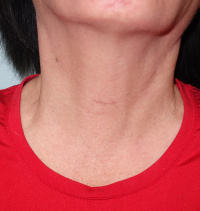 Minimally invasive video-assisted  (MIVA) thyroid and parathyroid surgery 2
