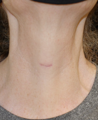 Minimally invasive video-assisted  (MIVA) thyroid and parathyroid surgery 3