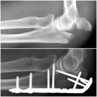 Olecranon Fracture at time of injury and 6 months post-op. 2